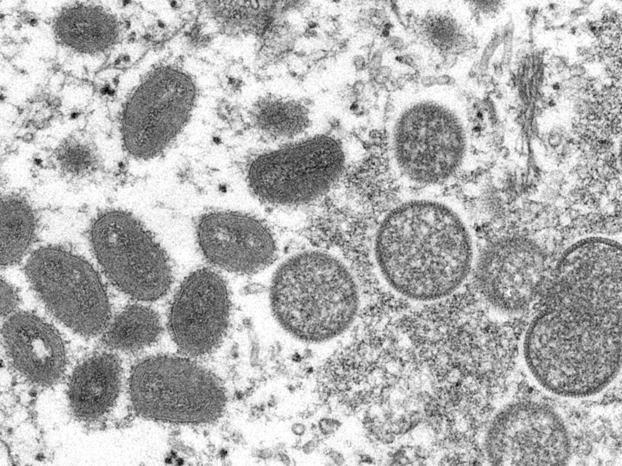 Variole du singe : flambée des cas dans les Amériques mais lente décrue de l’infection en Europe